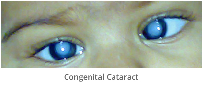 child congenital cataract treatment in gurgaon
