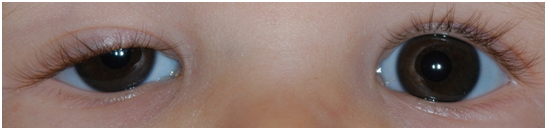 child drooping eyelid treatment