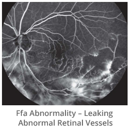 ffa-abnormality-leaking-abnormal-retinal-vessels