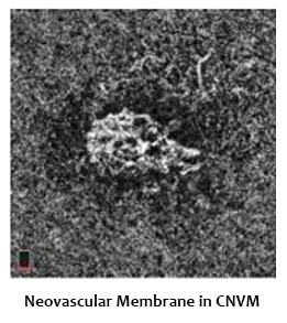 neovascular-membrane-CNVM-2