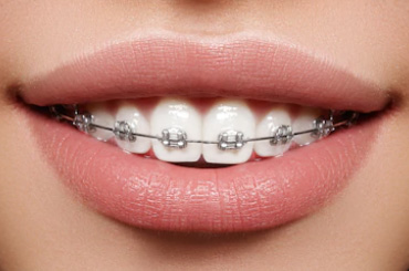 tooth-braces-clinic-gurgaon